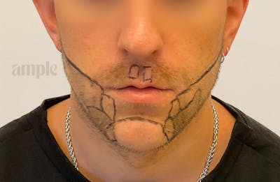Beard Transplants Before & After Gallery - Patient 949057 - Image 1