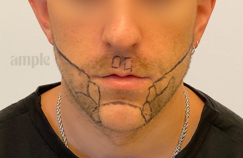 Beard Transplants Before & After Gallery - Patient 949057 - Image 1