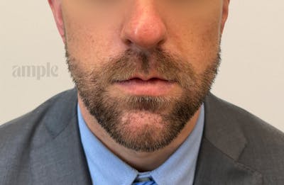 Beard Transplants Before & After Gallery - Patient 949057 - Image 2