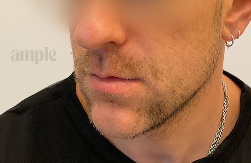 Beard Transplants Before & After Gallery - Patient 949057 - Image 5