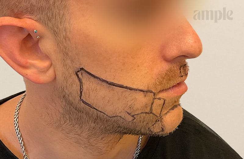 Beard Transplants Before & After Gallery - Patient 949057 - Image 3