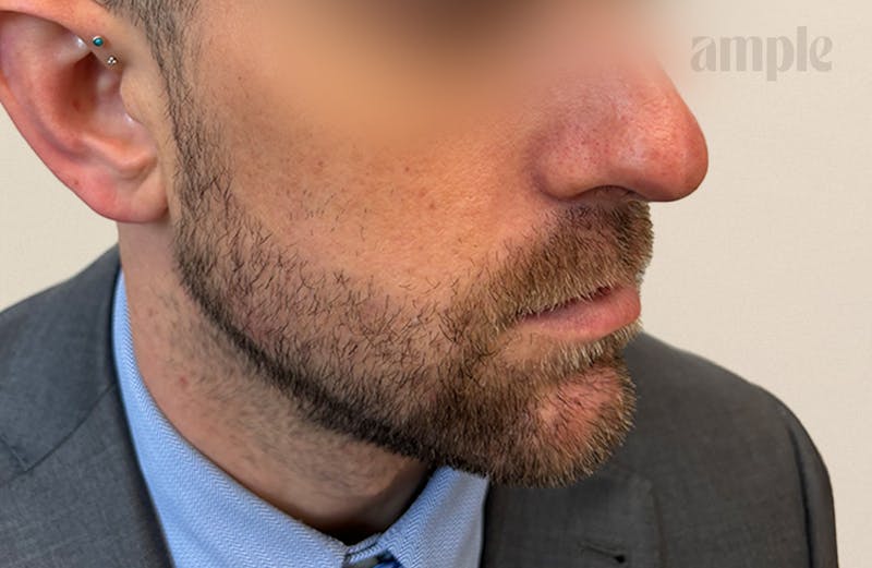 Beard Transplants Before & After Gallery - Patient 949057 - Image 4