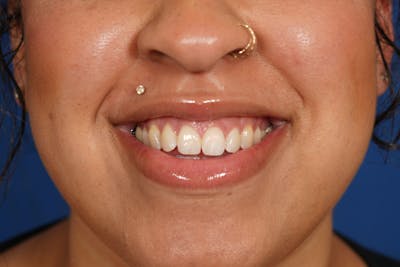 BOTOX Before & After Gallery - Patient 212643 - Image 1