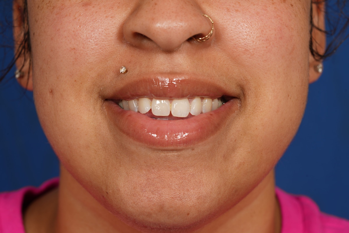 BOTOX Before & After Gallery - Patient 212643 - Image 2