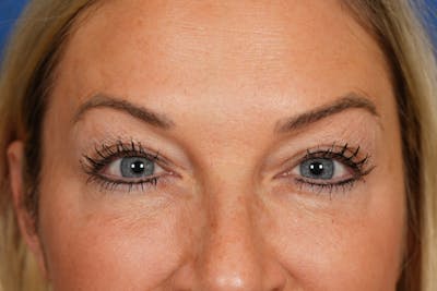 BOTOX Before & After Gallery - Patient 115309 - Image 2