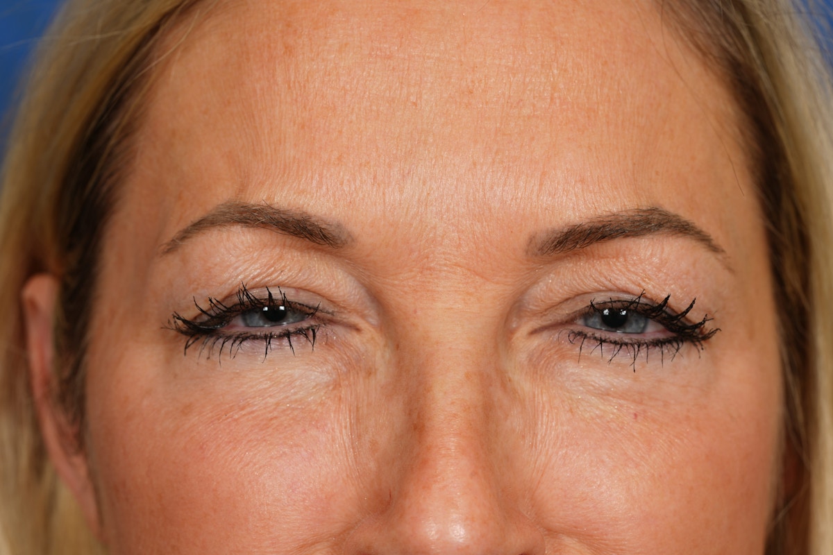 BOTOX Before & After Gallery - Patient 115309 - Image 8