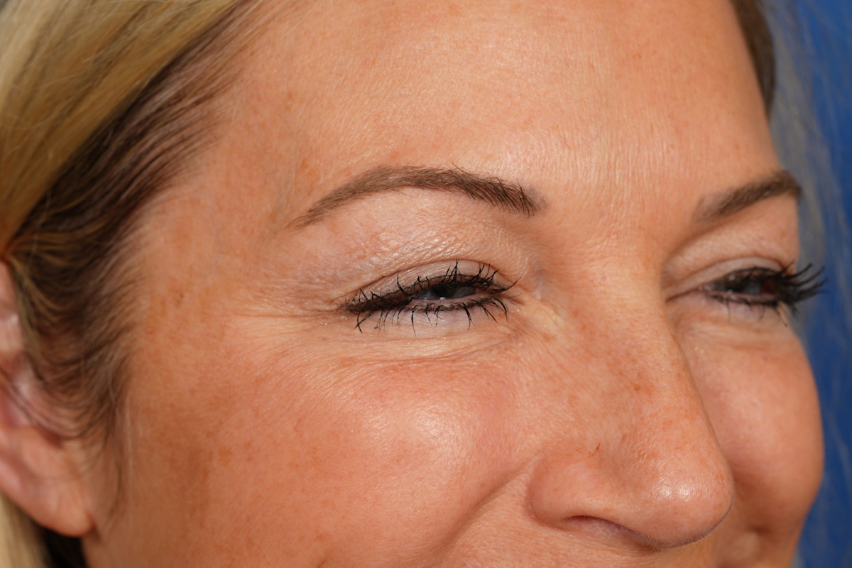 BOTOX Before & After Gallery - Patient 115309 - Image 4