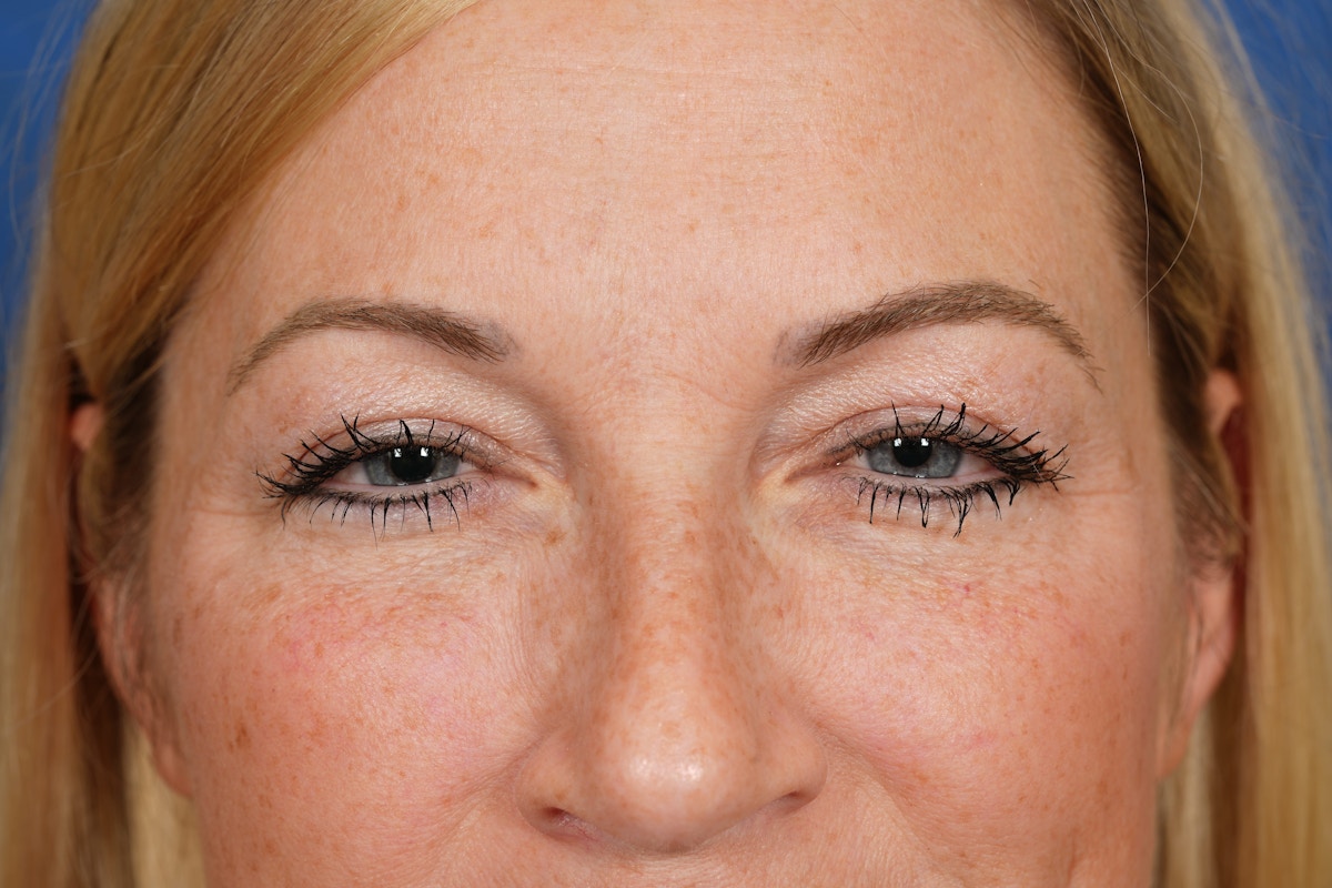 BOTOX Before & After Gallery - Patient 115309 - Image 5