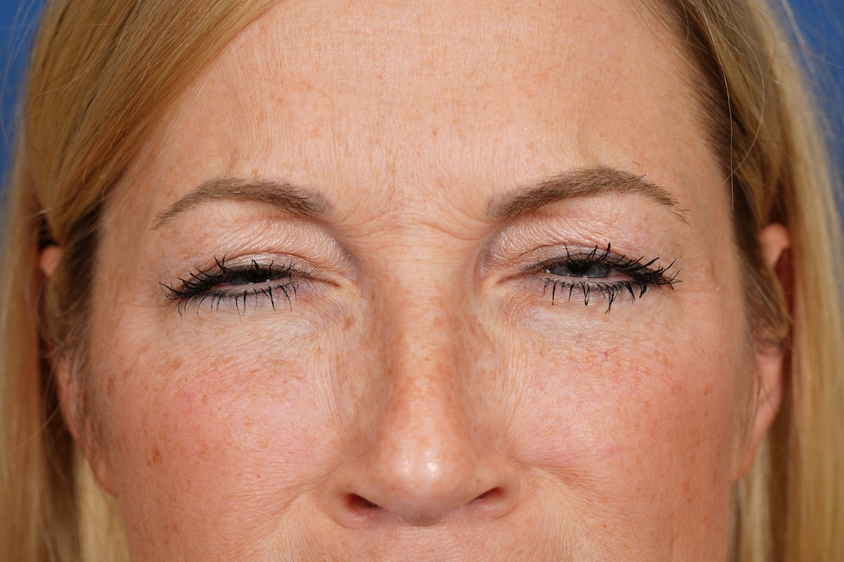 BOTOX Before & After Gallery - Patient 115309 - Image 7