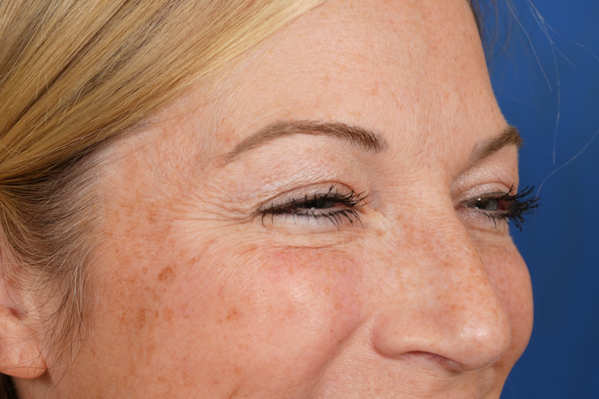 BOTOX Before & After Gallery - Patient 115309 - Image 3