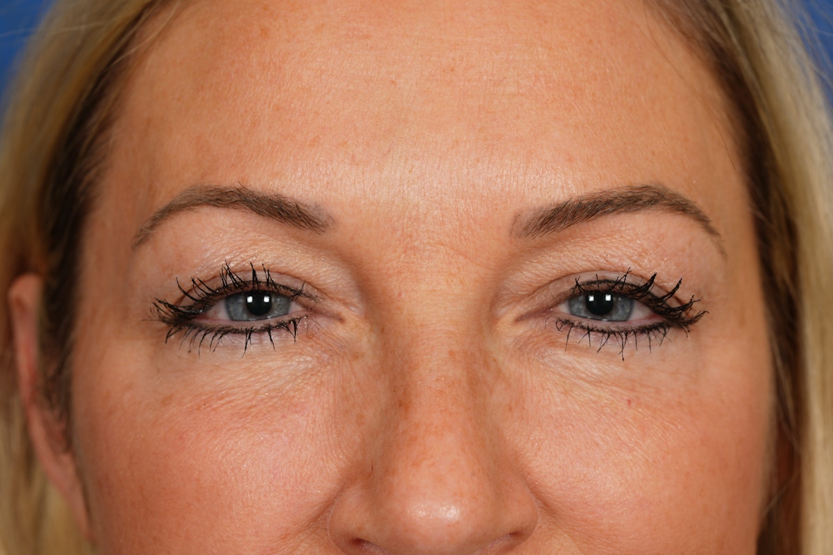 BOTOX Before & After Gallery - Patient 115309 - Image 6