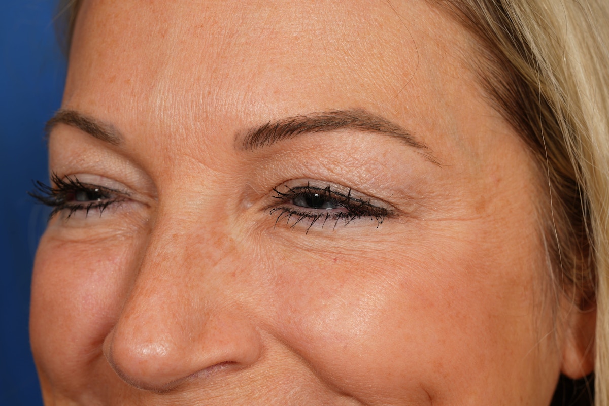 BOTOX Before & After Gallery - Patient 115309 - Image 10
