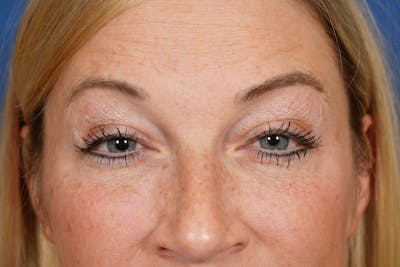 BOTOX Before & After Gallery - Patient 115309 - Image 1