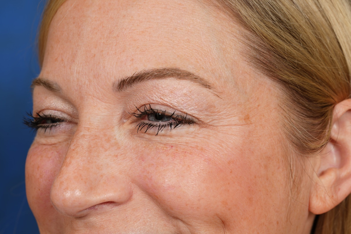 BOTOX Before & After Gallery - Patient 115309 - Image 9