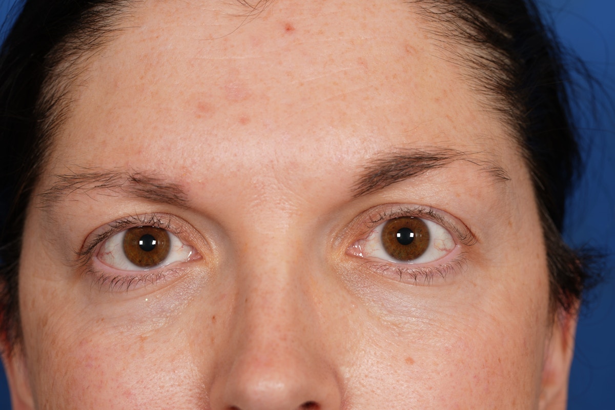 BOTOX Before & After Gallery - Patient 115331 - Image 5