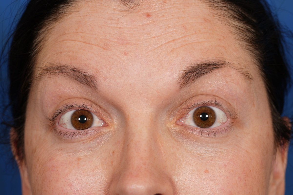 BOTOX Before & After Gallery - Patient 115331 - Image 3