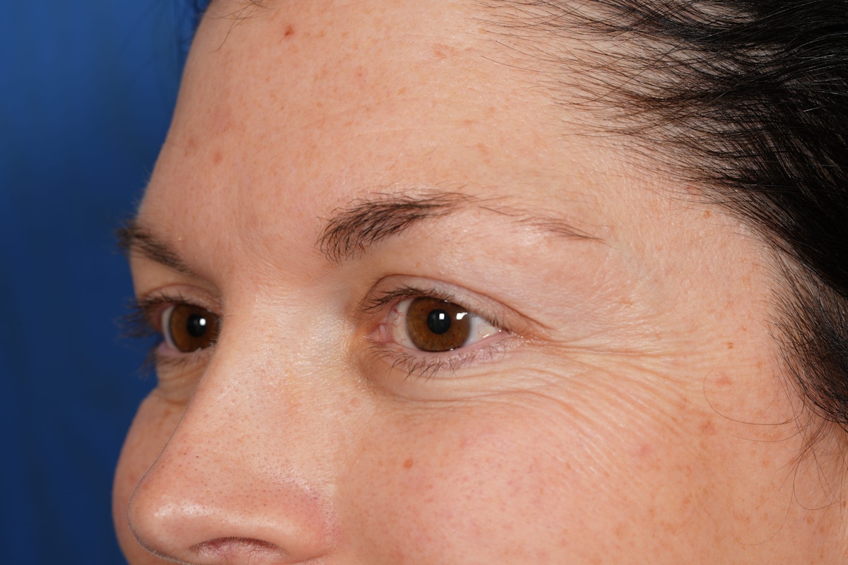 BOTOX Before & After Gallery - Patient 115331 - Image 7