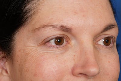 BOTOX Before & After Gallery - Patient 115331 - Image 1