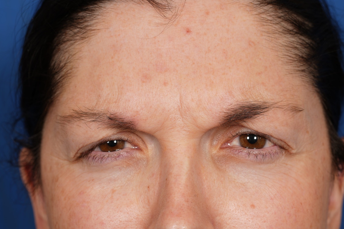 BOTOX Before & After Gallery - Patient 115331 - Image 9