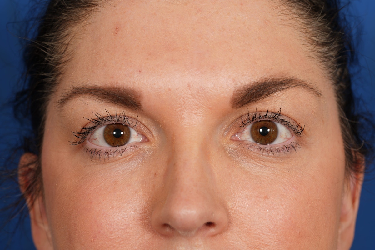 BOTOX Before & After Gallery - Patient 115331 - Image 6