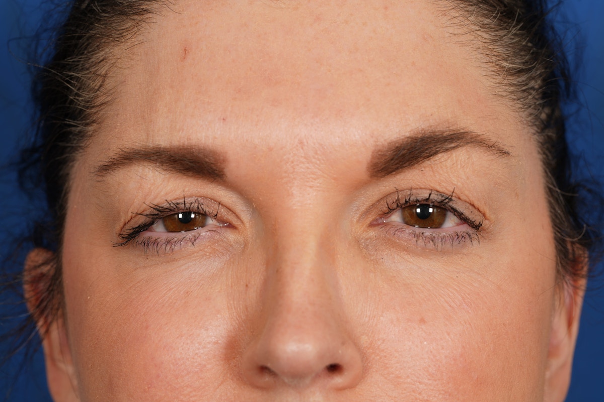 BOTOX Before & After Gallery - Patient 115331 - Image 10