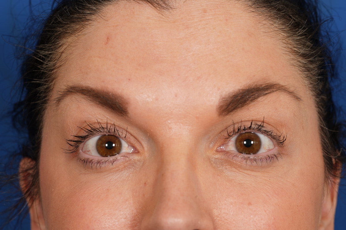 BOTOX Before & After Gallery - Patient 115331 - Image 4