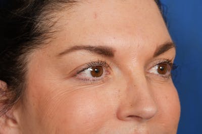 BOTOX Before & After Gallery - Patient 115331 - Image 2