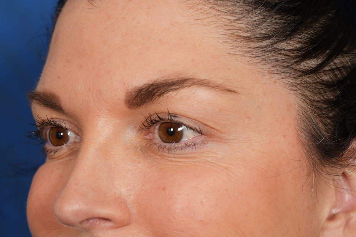 BOTOX Before & After Gallery - Patient 115331 - Image 8