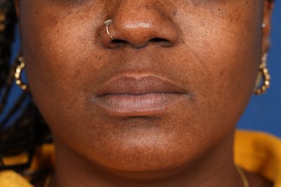Lip Filler Before & After Gallery - Patient 110328 - Image 1