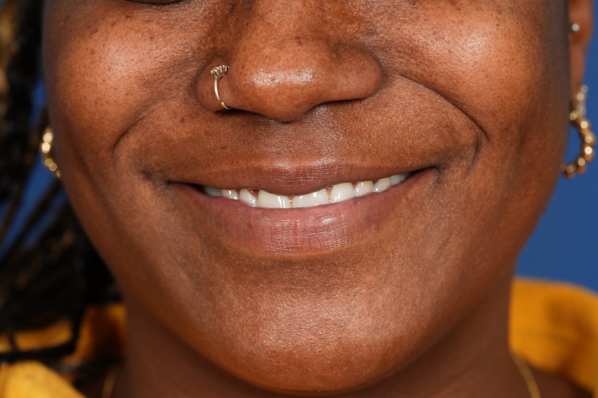 Lip Filler Before & After Gallery - Patient 110328 - Image 3