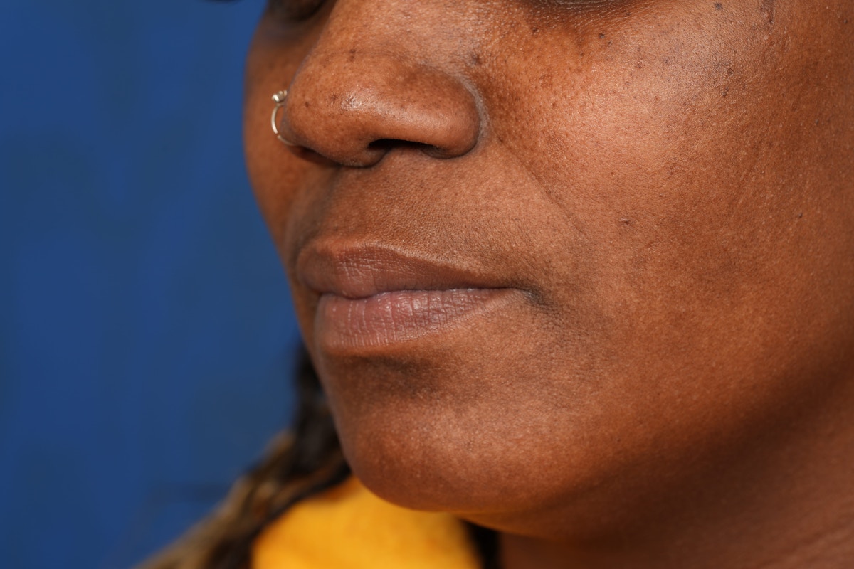 Lip Filler Before & After Gallery - Patient 110328 - Image 9