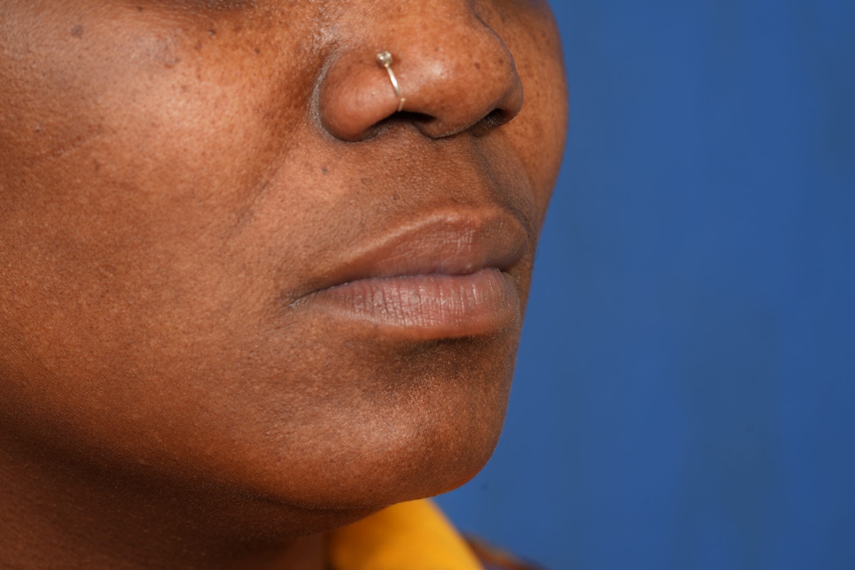 Lip Filler Before & After Gallery - Patient 110328 - Image 5