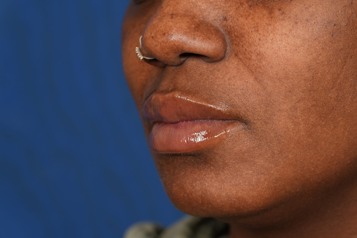 Lip Filler Before & After Gallery - Patient 110328 - Image 10