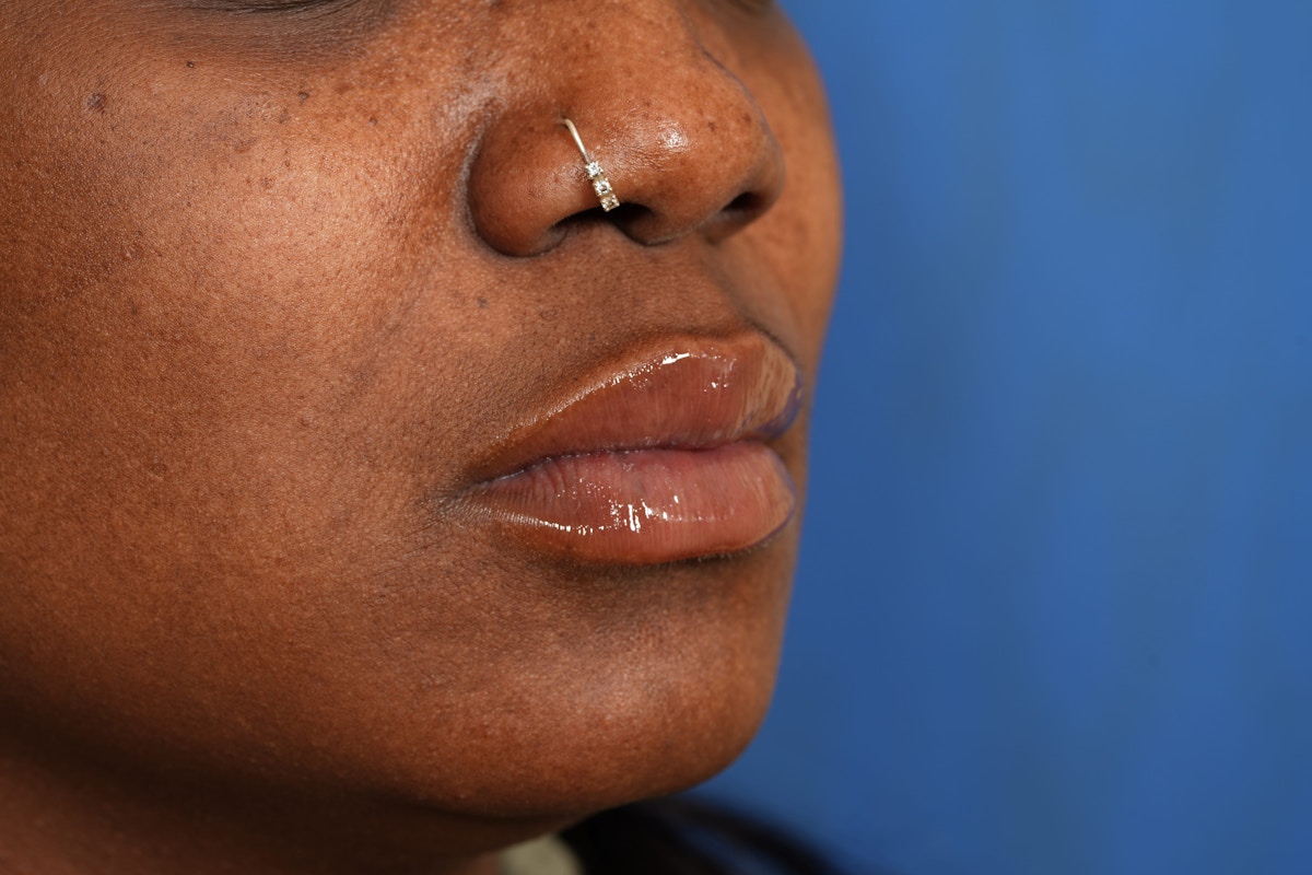 Lip Filler Before & After Gallery - Patient 110328 - Image 6