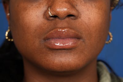 Lip Filler Before & After Gallery - Patient 110328 - Image 2