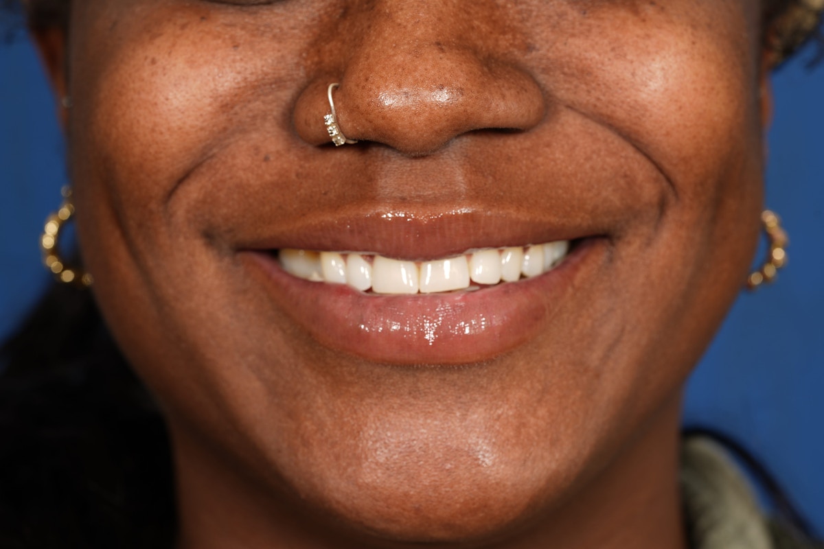 Lip Filler Before & After Gallery - Patient 110328 - Image 4