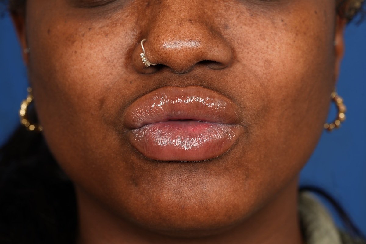 Lip Filler Before & After Gallery - Patient 110328 - Image 8