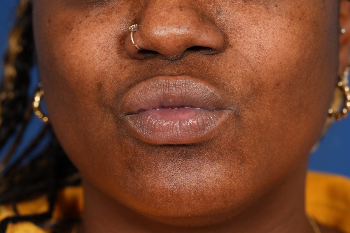 Lip Filler Before & After Gallery - Patient 110328 - Image 7