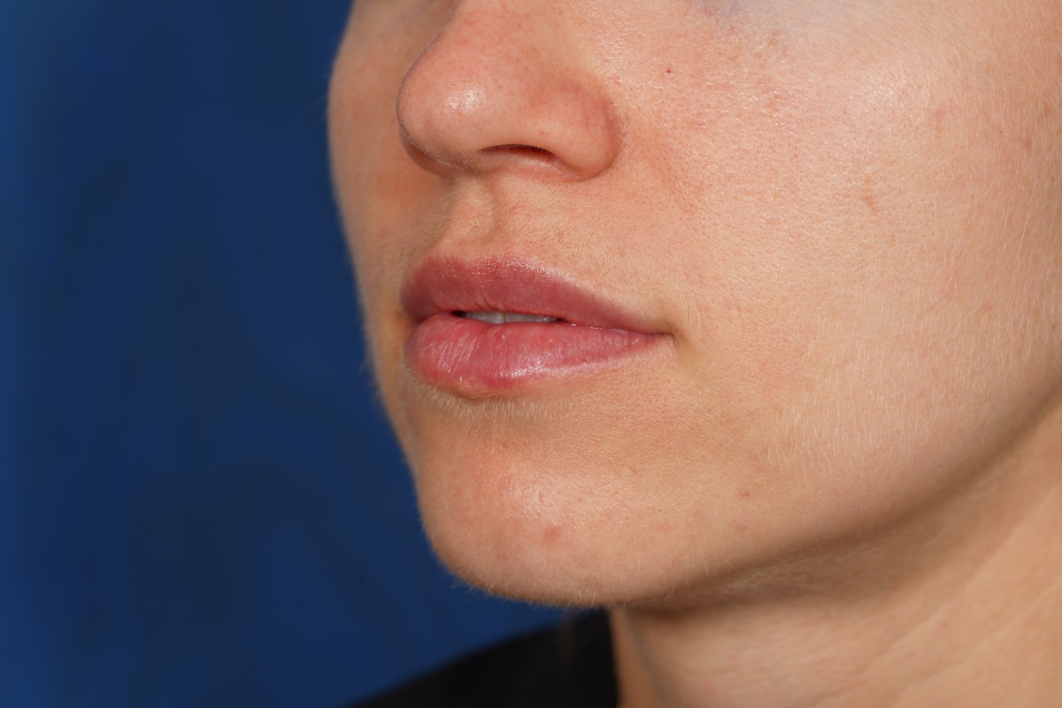 Lip Filler Before & After Gallery - Patient 388577 - Image 4