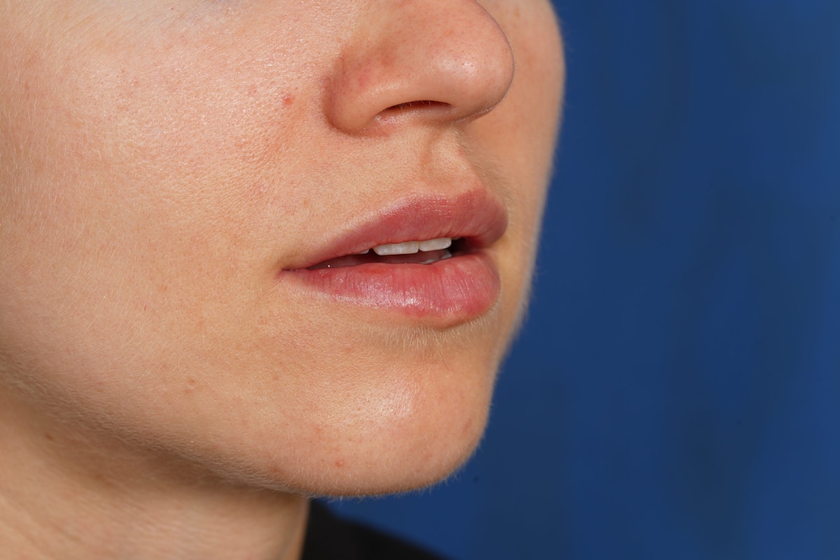 Lip Filler Before & After Gallery - Patient 388577 - Image 10