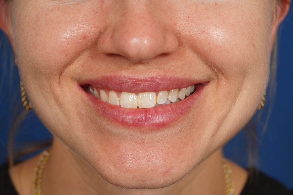 Lip Filler Before & After Gallery - Patient 388577 - Image 6