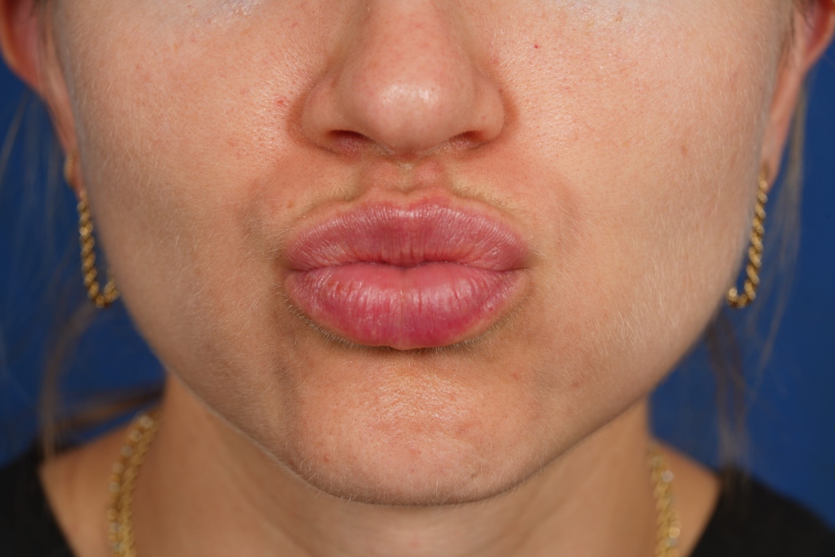 Lip Filler Before & After Gallery - Patient 388577 - Image 8