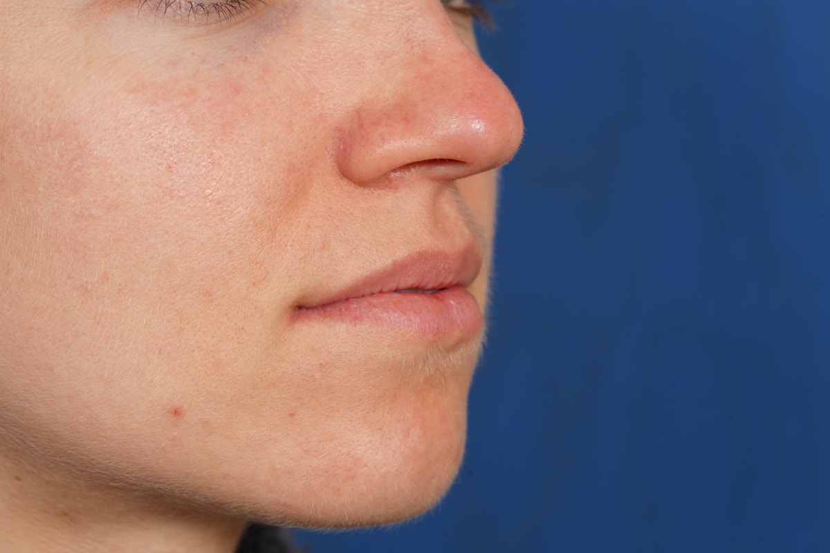 Lip Filler Before & After Gallery - Patient 388577 - Image 9