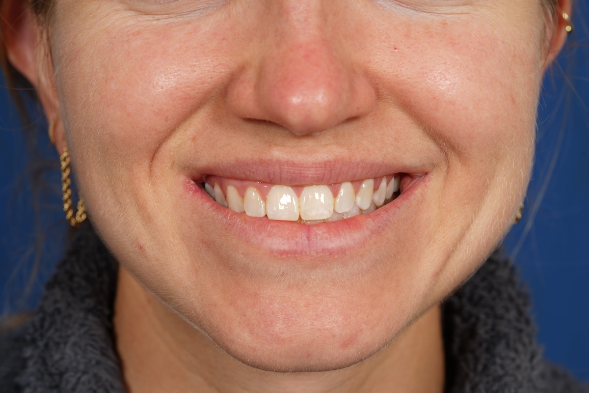Lip Filler Before & After Gallery - Patient 388577 - Image 5