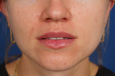 Lip Filler Before & After Gallery - Patient 388577 - Image 2