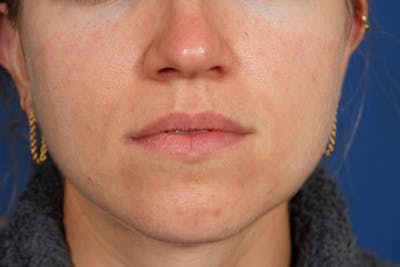 Lip Filler Before & After Gallery - Patient 388577 - Image 1