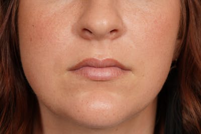 Lip Filler Before & After Gallery - Patient 361082 - Image 1