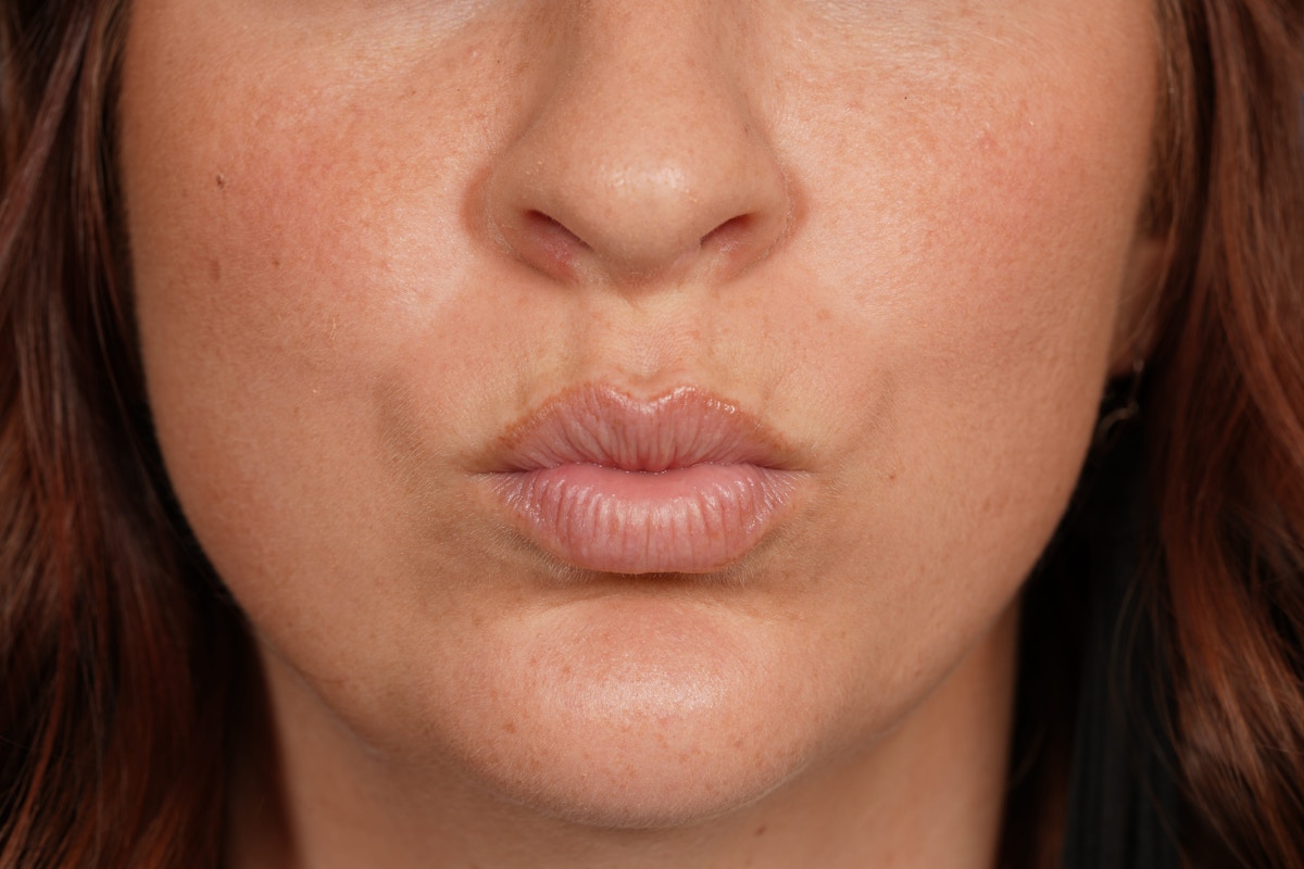 Lip Filler Before & After Gallery - Patient 361082 - Image 5