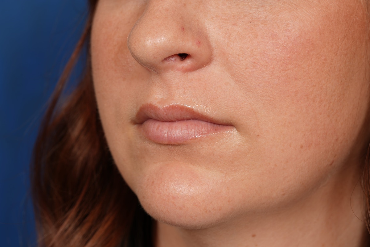 Lip Filler Before & After Gallery - Patient 361082 - Image 8