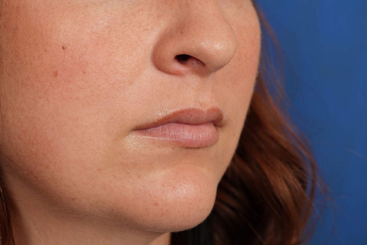Lip Filler Before & After Gallery - Patient 361082 - Image 3
